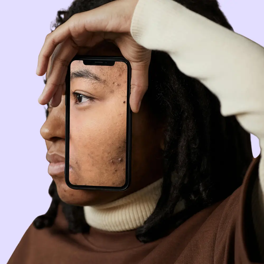 black teen with acne holding a phone to her face to show breakout