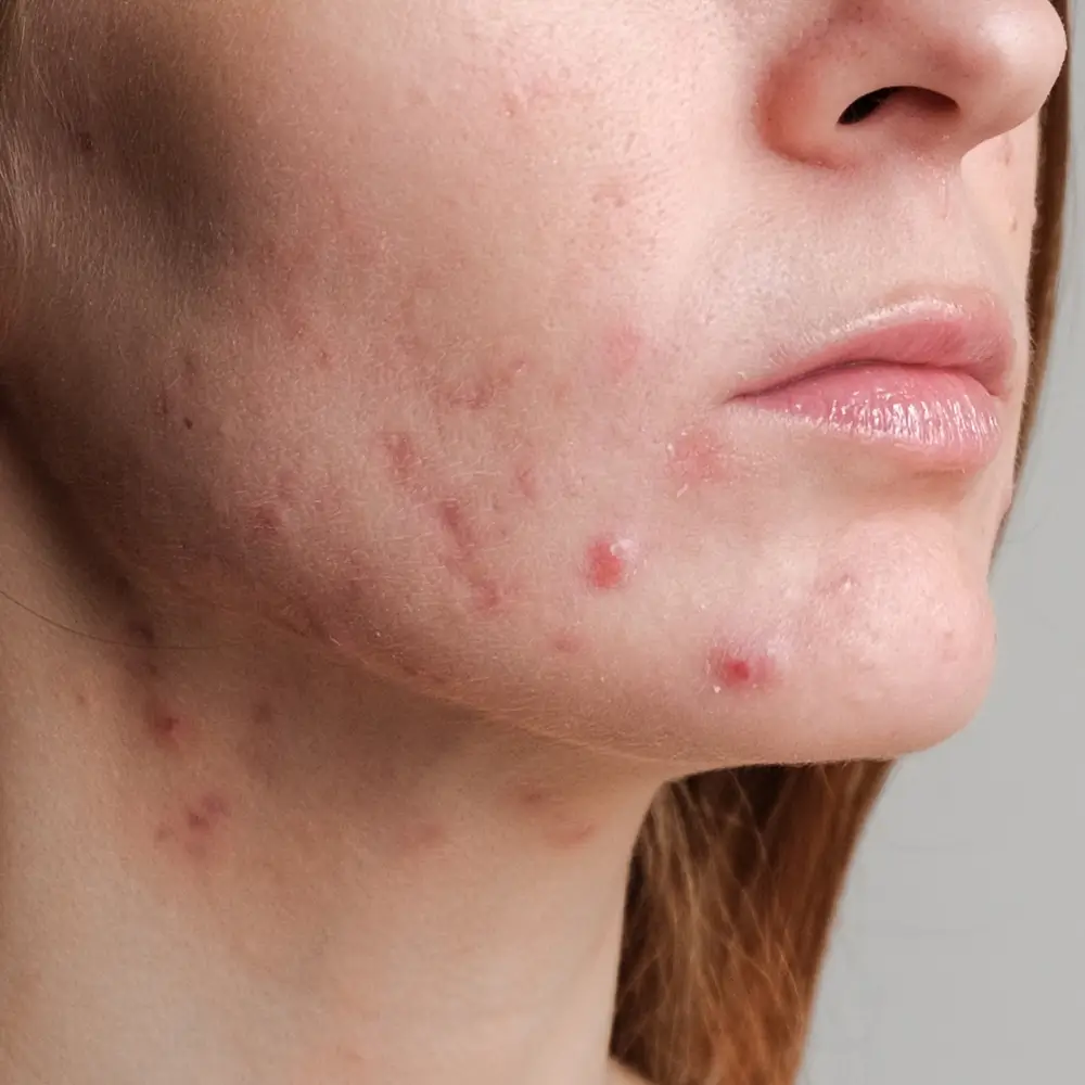 close up of skin with acne, enlarged pores, congestion