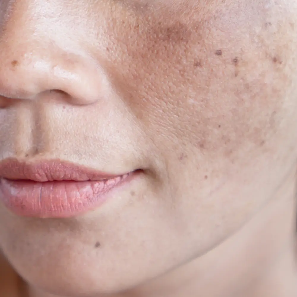 close up of skin with pigmentation