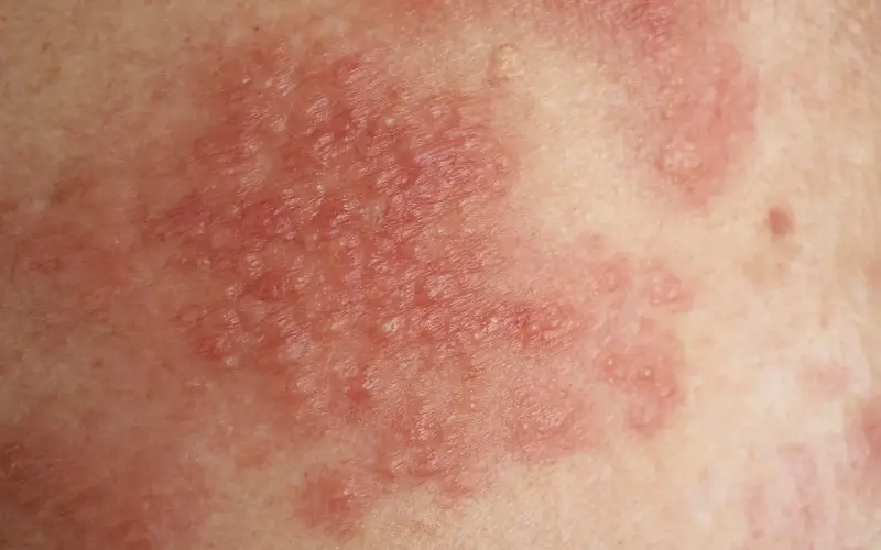 Close-up of a dry, inflamed eczema or psoriasis patch on the back of a leg, showing redness and scaling on medium toned skin.