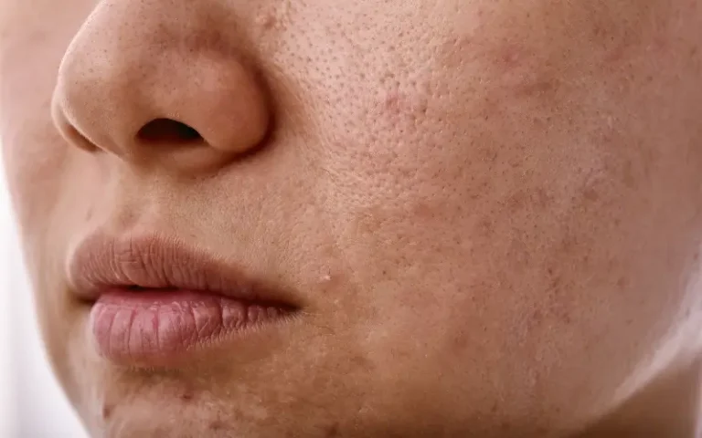 close up of a face with acne breakout neutral skin tone. Understanding acne causes including hormones, inflammation, and skin barrier health.