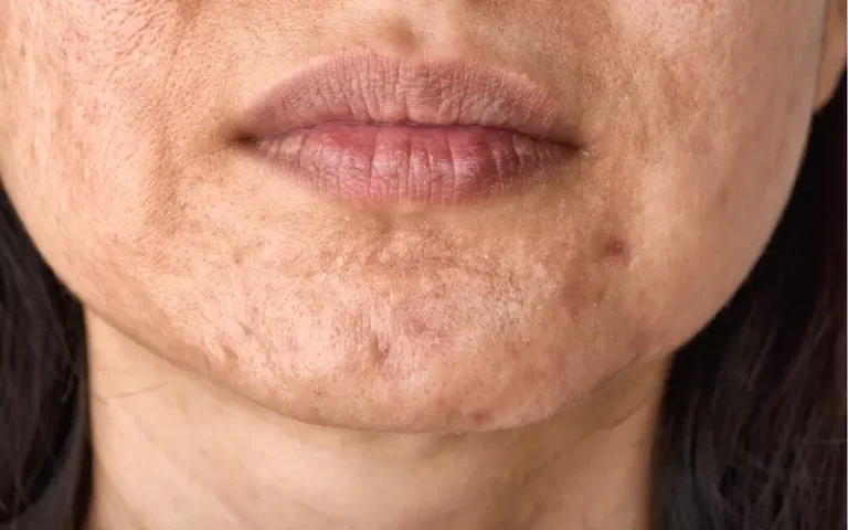 Close-up of acne-prone skin with visible red and brown post-acne marks, natural texture, no heavy retouching.