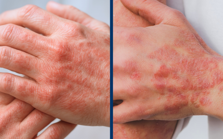 close up image of two hands displaying symptoms of Eczema vs Psoriasis