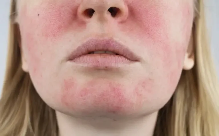 Close up of a person with natural, unretouched central facial redness and visible small vessels on the cheeks