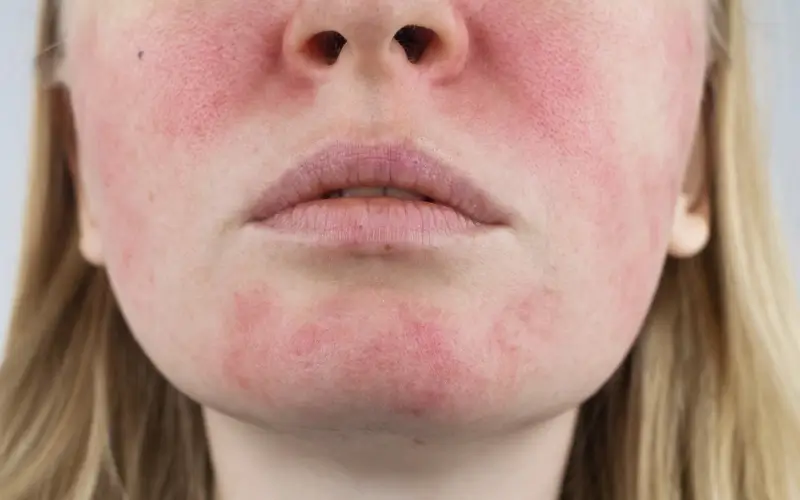 Close up of a person with natural, unretouched central facial redness and visible small vessels on the cheeks